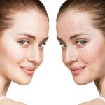 Buy Ultima-Accutane Online