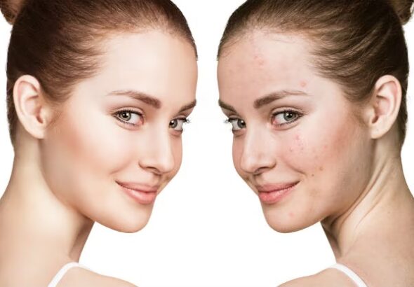 Buy Ultima-Accutane Online